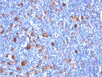 FSCN1 / Fascin Antibody - Formalin-fixed, paraffin-embedded human Hodgkin's lymphoma stained with Fascin antibody (SPM133).  This image was taken for the unmodified form of this product. Other forms have not been tested.