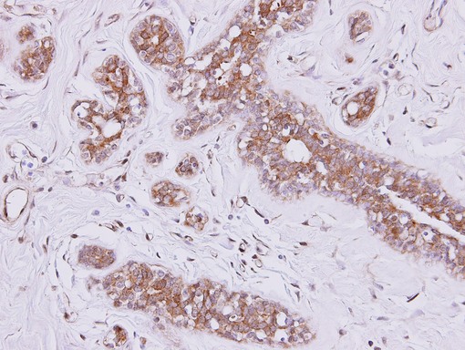 FSD2 Antibody - IHC of paraffin-embedded SAOS-2 xenograft using FSD2 antibody at 1:500 dilution.