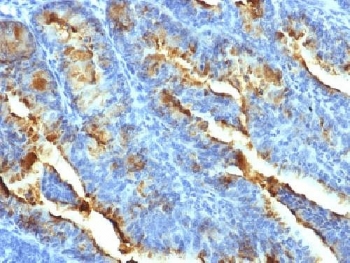 FSH Receptor / FSHR Antibody - IHC testing of FFPE human uterine carcinoma with FSHR antibody (clone FSHR/1400). Required HIER: boil tissue sections in 10mM Tris with 1mM EDTA, pH 9, or 10mM citrate buffer, pH6, for 10-20 min.