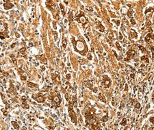FSH Receptor / FSHR Antibody - Immunohistochemistry of paraffin-embedded human gastric cancer tissue using FSHR antibody.