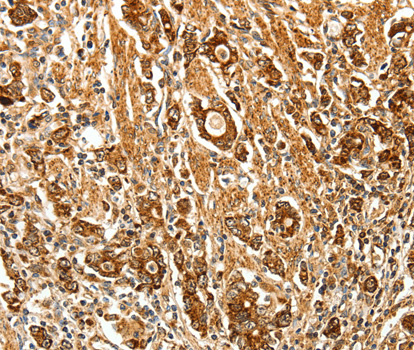 FSH Receptor / FSHR Antibody - Immunohistochemistry of paraffin-embedded human gastric cancer tissue using FSHR antibody.