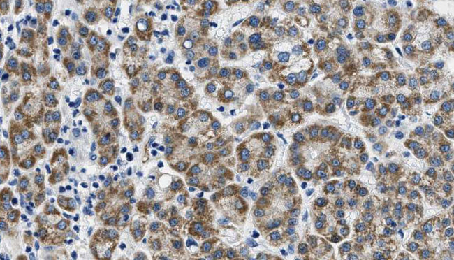 FSH Receptor / FSHR Antibody - 1:100 staining human liver carcinoma tissues by IHC-P. The sample was formaldehyde fixed and a heat mediated antigen retrieval step in citrate buffer was performed. The sample was then blocked and incubated with the antibody for 1.5 hours at 22°C. An HRP conjugated goat anti-rabbit antibody was used as the secondary.