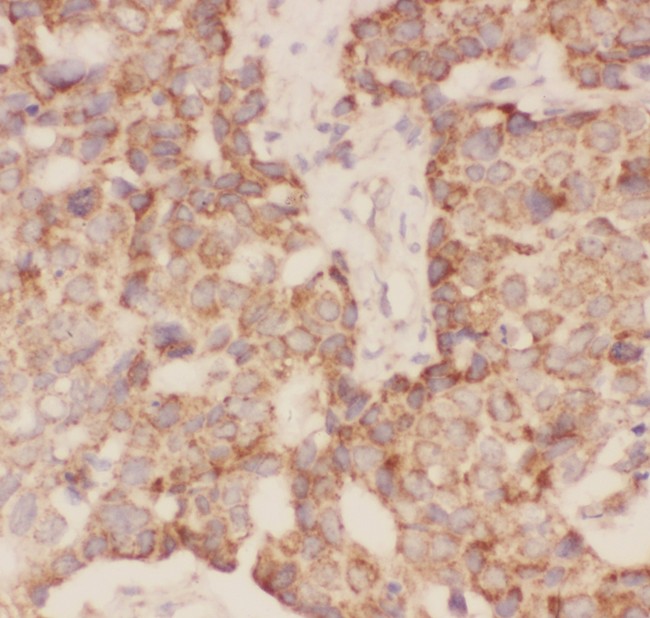 FSHB / FSH Beta Antibody - FSH beta antibody IHC-paraffin: Human Mammary Cancer Tissue.