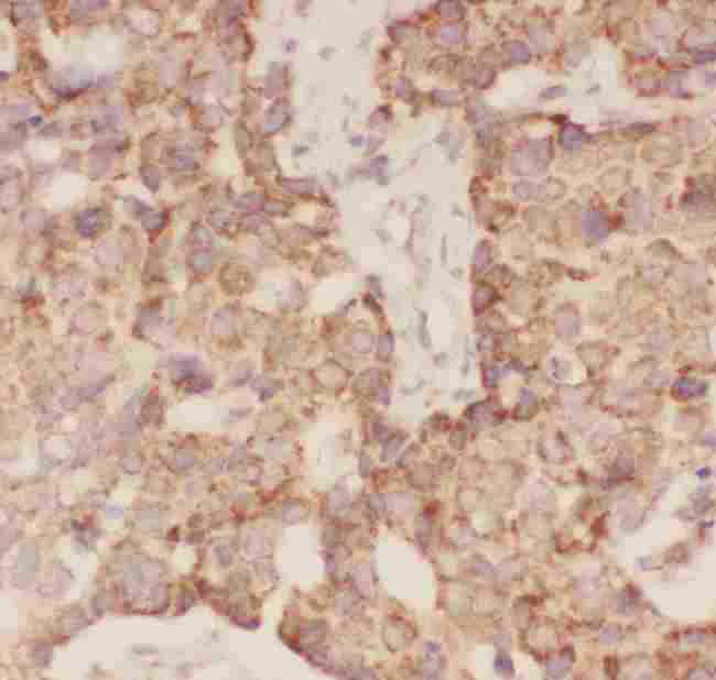 FSHB / FSH Beta Antibody - Anti-FSH beta Picoband antibody, IHC(P): Human Mammary Cancer Tissue