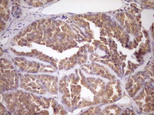 FSIP1 Antibody - Immunohistochemical staining of paraffin-embedded Human thyroid tissue within the normal limits using anti-FSIP1 mouse monoclonal antibody. (Heat-induced epitope retrieval by Tris-EDTA, pH8.0)(1:150)
