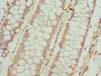 FSIP1 Antibody - Immunohistochemistry of paraffin-embedded human colon cancer using antibody at dilution of 1:100.