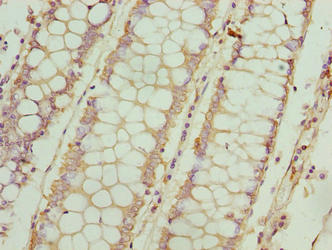 FSIP1 Antibody - Immunohistochemistry of paraffin-embedded human colon cancer using FSIP1 Antibody at dilution of 1:100