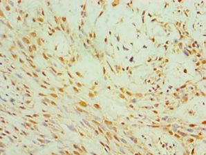 FSP27 / CIDEC Antibody - Immunohistochemistry of paraffin-embedded human breast cancer using antibody at 1:100 dilution.