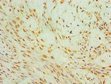 FSP27 / CIDEC Antibody - Immunohistochemistry of paraffin-embedded human breast cancer using antibody at 1:100 dilution.