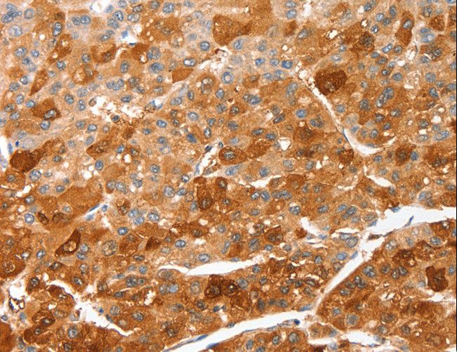 FSP27 / CIDEC Antibody - Immunohistochemistry of paraffin-embedded Human liver cancer using CIDEC Polyclonal Antibody at dilution of 1:50.