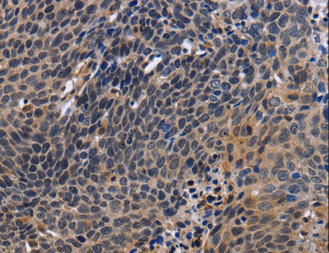 FSTL1 Antibody - Immunohistochemistry of paraffin-embedded Human cervical cancer using FSTL1 Polyclonal Antibody at dilution of 1:30.