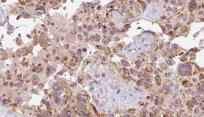 FSTL1 Antibody - 1:100 staining human Melanoma tissue by IHC-P. The sample was formaldehyde fixed and a heat mediated antigen retrieval step in citrate buffer was performed. The sample was then blocked and incubated with the antibody for 1.5 hours at 22°C. An HRP conjugated goat anti-rabbit antibody was used as the secondary.
