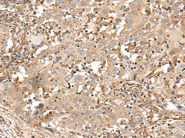 FSTL5 Antibody - Immunohistochemistry of paraffin-embedded Human cervical cancer tissue  using FSTL5 Polyclonal Antibody at dilution of 1:50(×200)