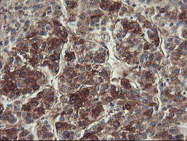 FTCD / 58K Golgi Protein Antibody - IHC of paraffin-embedded Carcinoma of Human liver tissue using anti-FTCD mouse monoclonal antibody.