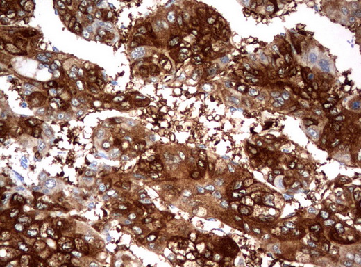 FTCD / 58K Golgi Protein Antibody - Immunohistochemical staining of paraffin-embedded Carcinoma of Human liver tissue using anti-FTCDmouse monoclonal antibody.  heat-induced epitope retrieval by 10mM citric buffer, pH6.0, 120C for 3min)