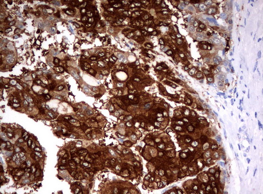 FTCD / 58K Golgi Protein Antibody - Immunohistochemical staining of paraffin-embedded Carcinoma of Human liver tissue using anti-FTCD mouse monoclonal antibody.  heat-induced epitope retrieval by 10mM citric buffer, pH6.0, 120C for 3min)