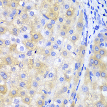 FTH1 / Ferritin Heavy Chain Antibody - Immunohistochemistry of paraffin-embedded human liver cancer tissue.