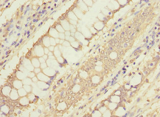 FTHFSDC1 / MTHFD1L Antibody - Immunohistochemistry of paraffin-embedded human colon cancer at dilution 1:100
