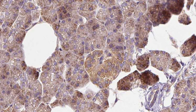 FTHFSDC1 / MTHFD1L Antibody - 1:100 staining human pancreas carcinoma tissue by IHC-P. The sample was formaldehyde fixed and a heat mediated antigen retrieval step in citrate buffer was performed. The sample was then blocked and incubated with the antibody for 1.5 hours at 22°C. An HRP conjugated goat anti-rabbit antibody was used as the secondary.