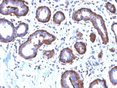 FTL / Ferritin Light Chain Antibody - Formalin-fixed, paraffin-embedded Human Breast Carcinoma stained with Ferritin LC Rabbit Recombinant Monoclonal Antibody (FTL/2338R).