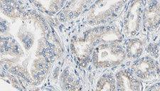 FTL / Ferritin Light Chain Antibody - 1:100 staining human prostate tissue by IHC-P. The sample was formaldehyde fixed and a heat mediated antigen retrieval step in citrate buffer was performed. The sample was then blocked and incubated with the antibody for 1.5 hours at 22°C. An HRP conjugated goat anti-rabbit antibody was used as the secondary.