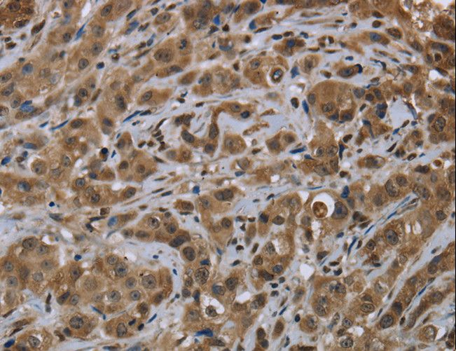 FTO Antibody - Immunohistochemistry of paraffin-embedded Human breast cancer using FTO Polyclonal Antibody at dilution of 1:60.