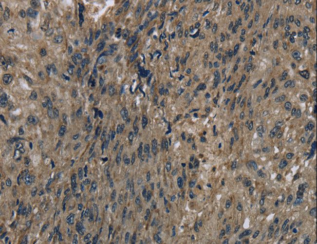 FTO Antibody - Immunohistochemistry of paraffin-embedded Human esophagus cancer using FTO Polyclonal Antibody at dilution of 1:60.