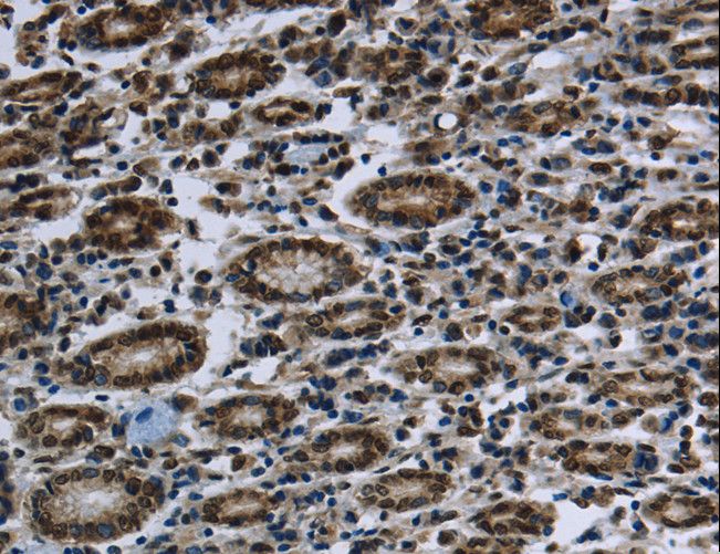 FTO Antibody - Immunohistochemistry of paraffin-embedded Human gastric cancer using FTO Polyclonal Antibody at dilution of 1:60.