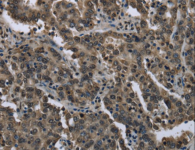 FTO Antibody - Immunohistochemistry of paraffin-embedded Human liver cancer using FTO Polyclonal Antibody at dilution of 1:60.