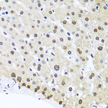 FUBP1 Antibody - Immunohistochemistry of paraffin-embedded human liver injury tissue.