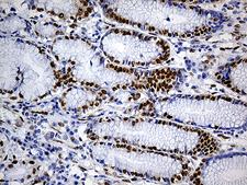 FUBP3 Antibody - Immunohistochemical staining of paraffin-embedded Human Gastric Carcinoma using anti-FUBP3 mouse monoclonal antibody. (Heat-induced epitope retrieval by 1mM EDTA in 10mM Tris buffer. (pH8.5) at 120°C for 3 min. (1:500)