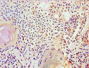FUBP3 Antibody - Immunohistochemistry of paraffin-embedded human breast cancer using antibody at 1:100 dilution.