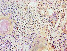 FUBP3 Antibody - Immunohistochemistry of paraffin-embedded human breast cancer using antibody at 1:100 dilution.