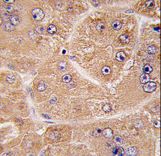 FUCA2 Antibody - Formalin-fixed and paraffin-embedded human hepatocarcinoma tissue reacted with FUCA2 antibody , which was peroxidase-conjugated to the secondary antibody, followed by DAB staining. This data demonstrates the use of this antibody for immunohistochemistry; clinical relevance has not been evaluated.