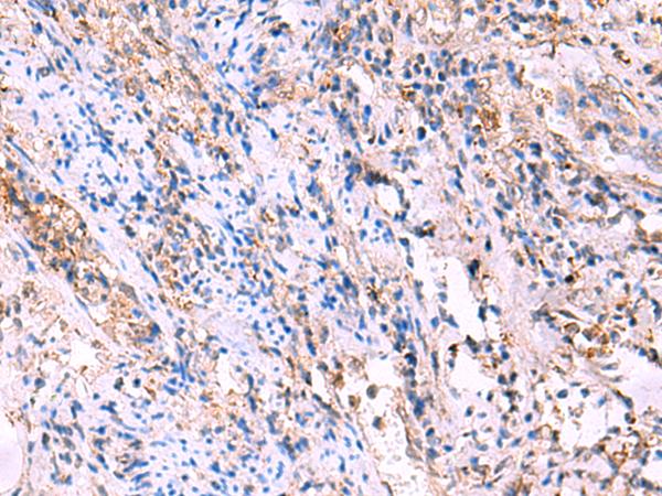 FUCA2 Antibody - Immunohistochemistry of paraffin-embedded Human cervical cancer tissue  using FUCA2 Polyclonal Antibody at dilution of 1:70(×200)