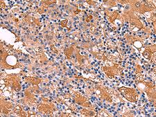 FUCA2 Antibody - Immunohistochemistry of paraffin-embedded Human liver cancer tissue  using FUCA2 Polyclonal Antibody at dilution of 1:80(×200)