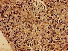 FUNDC1 Antibody - Immunohistochemistry of paraffin-embedded human glioma cancer at dilution of 1:100