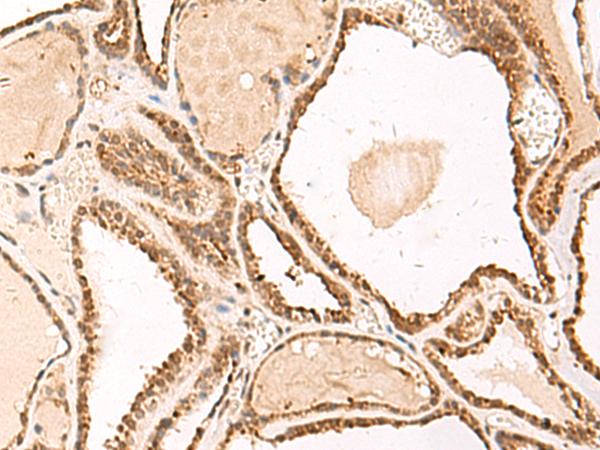 FUNDC2 Antibody - Immunohistochemistry of paraffin-embedded Human thyroid cancer tissue  using FUNDC2 Polyclonal Antibody at dilution of 1:50(×200)