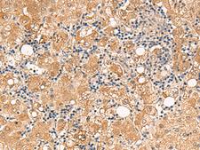FUNDC2 Antibody - Immunohistochemistry of paraffin-embedded Human liver cancer tissue  using FUNDC2 Polyclonal Antibody at dilution of 1:60(×200)