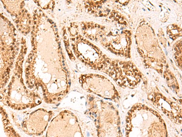 FUNDC2 Antibody - Immunohistochemistry of paraffin-embedded Human thyroid cancer tissue  using FUNDC2 Polyclonal Antibody at dilution of 1:60(×200)