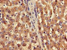 FUOM / C10orf125 Antibody - Immunohistochemistry of paraffin-embedded human liver cancer using FUOM Antibody at dilution of 1:100