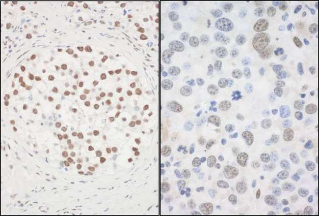 FUS / TLS Antibody - Detection of Human and Mouse FUS by Immunohistochemistry. Sample: FFPE sections of human testicular seminoma (left) and mouse hybridoma tumor (right). Antibody: Affinity purified rabbit anti-FUS used at a dilution of 1:1000 (1 ug/ml). Detection: DAB.