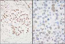 FUS / TLS Antibody - Detection of Human and Mouse FUS by Immunohistochemistry. Sample: FFPE sections of human testicular seminoma (left) and mouse hybridoma tumor (right). Antibody: Affinity purified rabbit anti-FUS used at a dilution of 1:1000 (1 ug/ml). Detection: DAB.