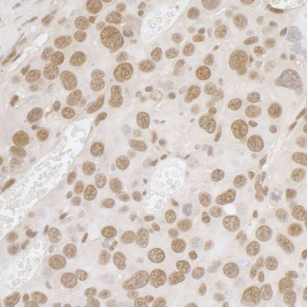 FUS / TLS Antibody - Detection of mouse FUS by immunohistochemistry. Sample: FFPE section of mouse renal cells carcinoma. Antibody: Affinity purified rabbit anti-FUS used at a dilution of 1:1,000 (1µg/ml). Detection: DAB