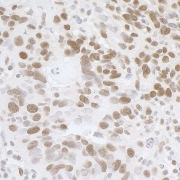 FUS / TLS Antibody - Detection of human FUS by immunohistochemistry. Sample: FFPE section of human ovarian carcinoma. Antibody: Affinity purified rabbit anti-FUS used at a dilution of 1:1,000 (1µg/ml). Detection: DAB