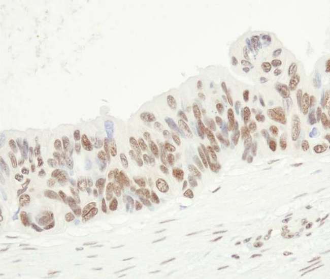 FUS / TLS Antibody - Detection of Human FUS by Immunohistochemistry. Sample: FFPE section of human ovarian carcinoma. Antibody: Affinity purified rabbit anti-FUS used at a dilution of 1:250. Detection: DAB staining using anti-Rabbit IHC antibody at a dilution of 1:100.