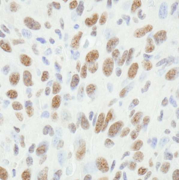 FUS / TLS Antibody - Detection of Mouse FUS by Immunohistochemistry. Sample: FFPE section of mouse squamous cell carcinoma. Antibody: Affinity purified rabbit anti-FUS used at a dilution of 1:250. Detection: DAB staining using anti-Rabbit IHC antibody at a dilution of 1:100.