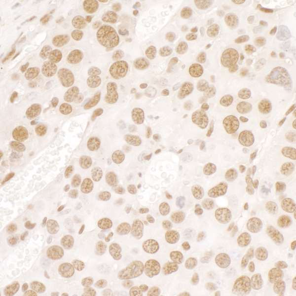 FUS / TLS Antibody - Detection of mouse FUS by immunohistochemistry. Sample: FFPE section of mouse renal cell carcinoma. Antibody: Affinity purified rabbit anti-FUS used at a dilution of 1:100. Detection: DAB