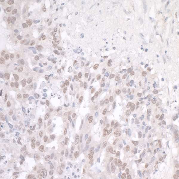 FUS / TLS Antibody - Detection of human FUS by immunohistochemistry. Sample: FFPE section of human ovarian carcinoma. Antibody: Affinity purified rabbit anti-FUS used at a dilution of 1:500. Detection: DAB staining using anti-rabbit IHC antibody