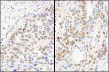 FUS / TLS Antibody - Detection of Human and Mouse FUS by Immunohistochemistry. Sample: FFPE section of human ovarian carcinoma (left) and mouse teratoma (right). Antibody: Affinity purified rabbit anti-FUS used at a dilution of 1:5000 (0.2and 1:1000 (1 Detection: DAB.